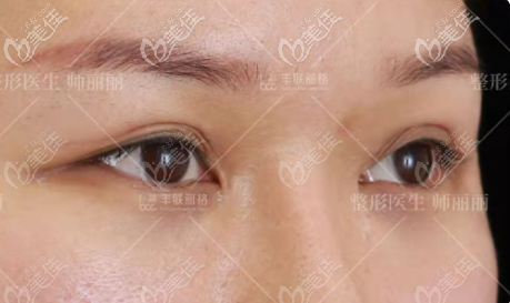 做全切雙眼皮修復(fù)前 做全切雙眼皮修復(fù)前