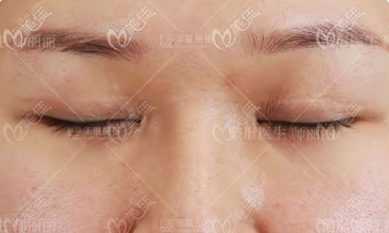 我找?guī)燐慃愋迯?fù)雙眼皮前閉眼情況 我找?guī)燐慃愋迯?fù)雙眼皮前閉眼情況