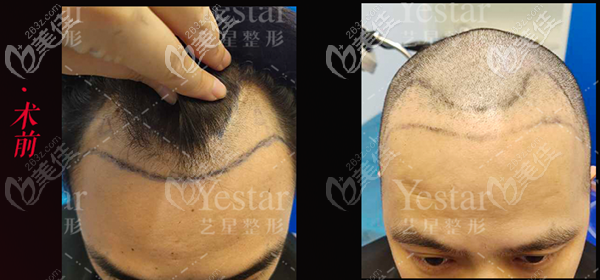 男士m型發(fā)際線植發(fā)案例 男士m型發(fā)際線植發(fā)案例
