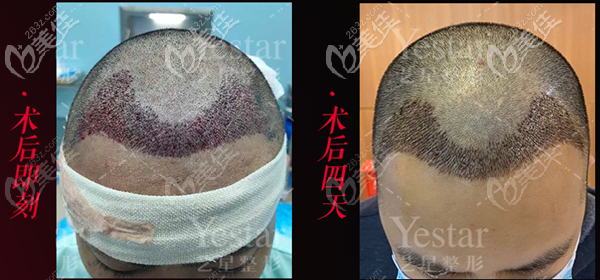 發(fā)際線植發(fā)術后即刻效果 發(fā)際線植發(fā)術后即刻效果