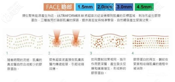 第三代7D聚拉提面部提升工作原理 第三代7D聚拉提面部提升工作原理