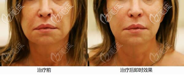 7D聚拉提術(shù)前和術(shù)后即刻效果對比圖 7D聚拉提術(shù)前和術(shù)后即刻效果對比圖