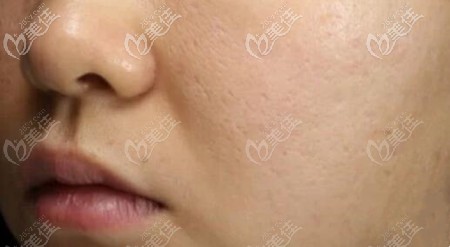 做了3次點陣激光后的效果