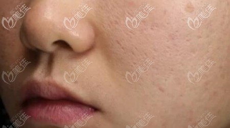 治療前的痘坑明顯