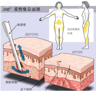 360環(huán)吸原理