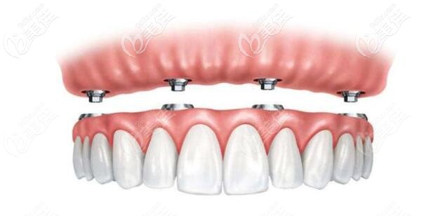 半口半固定種植 半口半固定種植