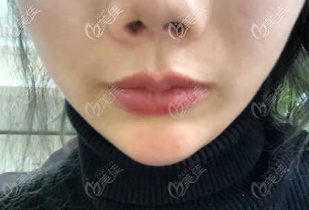 取出鼻假體15天鼻子攣縮成朝天鼻 取出鼻假體15天鼻子攣縮成朝天鼻