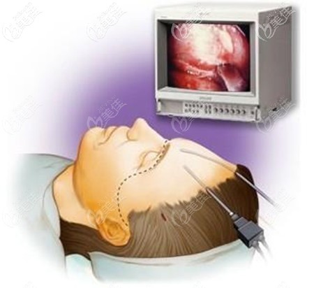 內(nèi)窺鏡拉皮除皺手術(shù) 內(nèi)窺鏡拉皮除皺手術(shù)