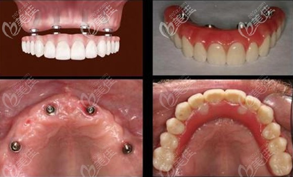70歲老人在北京瑞泰口腔豐臺(tái)醫(yī)院用4顆種植體解決了半口牙缺失...