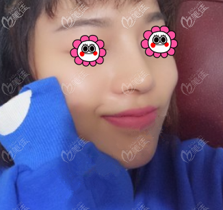 喬雅登玻尿酸隆鼻快一個月了 喬雅登玻尿酸隆鼻快一個月了