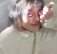 谷亦涵喬雅登玻尿酸隆鼻案例 谷亦涵喬雅登玻尿酸隆鼻案例