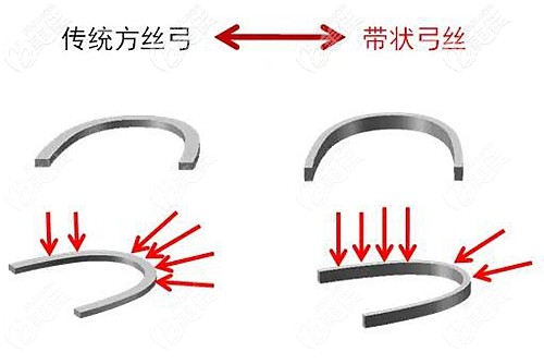 全同步帶狀弓牙套的優(yōu)點