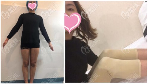 昆明夢(mèng)想整形大腿吸脂術(shù)后效果反饋