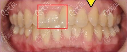 個(gè)別牙齒輕微反頜矯正前 個(gè)別牙齒輕微反頜矯正前