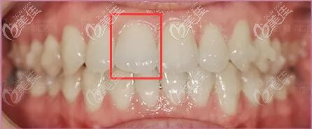 37歲寶媽個別牙齒輕度反頜,戴隱形活動矯正器1年半就OK嘍