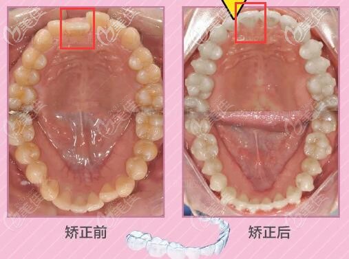 重慶樂樂欣口腔牙齒矯正案例 重慶樂樂欣口腔牙齒矯正案例
