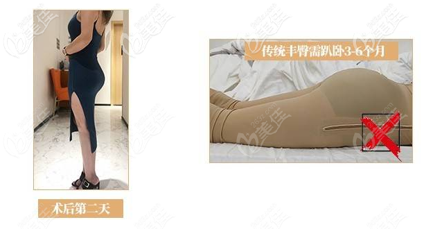 深圳曹孟君豐臀技術怎么樣