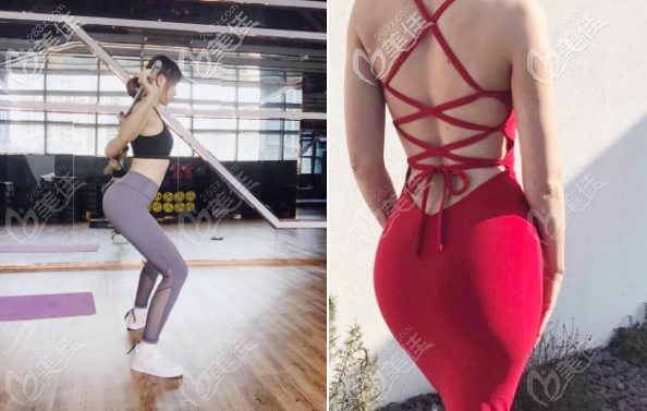 深圳曹孟君假體豐臀實例療效圖