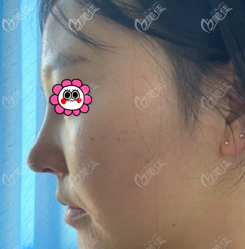 找薛軼群做鼻子有10幾天了