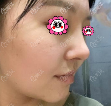 我做肋骨鼻綜合1個(gè)多月效果