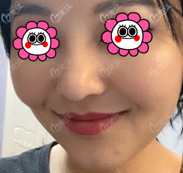 想找薛軼群做鼻子的伙伴往這看,這有我找他做的鼻綜合案例參考