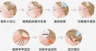 面部筋膜提升手術(shù)過程示意圖 面部筋膜提升手術(shù)過程示意圖
