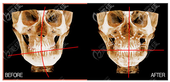 周會喜正頜手術(shù)做的怎么樣 周會喜正頜手術(shù)做的怎么樣