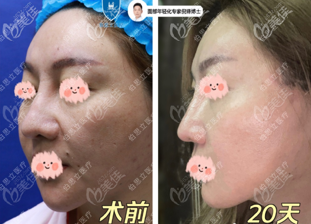 倪鋒面部小拉皮提升+面部吸脂+5G黃金微雕20天效果圖