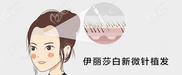 烏魯木齊伊麗莎白采用新微針植發(fā)