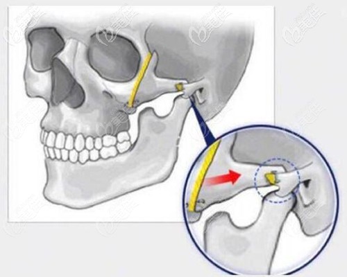 顴骨內(nèi)推固定鈦釘圖