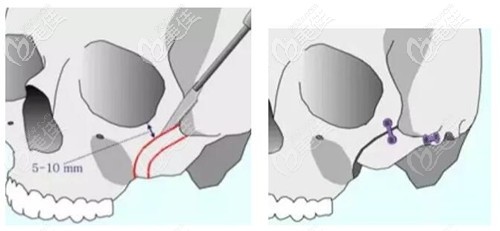 顴骨內(nèi)推手術(shù)截骨手術(shù)過程