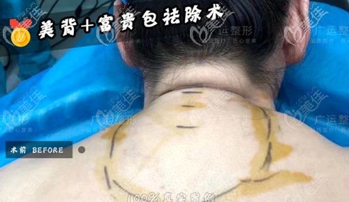 后頸部堆積的富貴包脂肪 后頸部堆積的富貴包脂肪