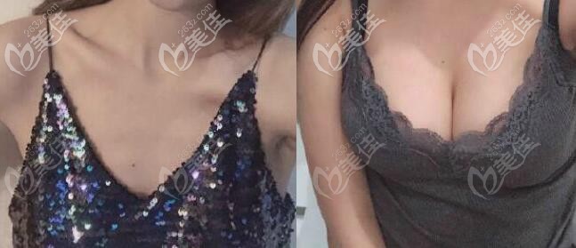 麥格280cc中凸恢復(fù)三個(gè)月后效果圖片 麥格280cc中凸恢復(fù)三個(gè)月后效果圖片