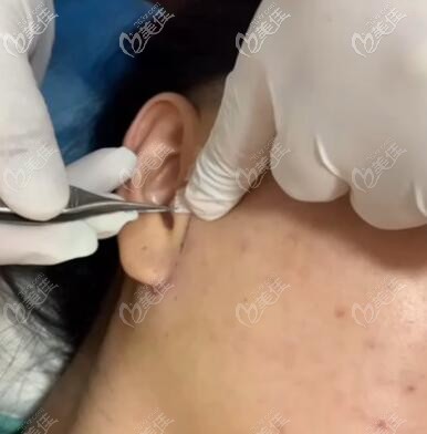 小拉皮手術(shù)切口位置展示 小拉皮手術(shù)切口位置展示