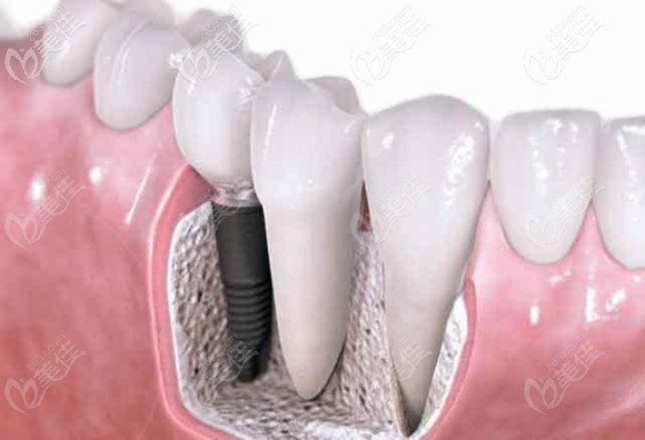 于洪海醫(yī)生擅長牙齒種植技術(shù) 于洪海醫(yī)生擅長牙齒種植技術(shù)