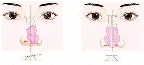 唇裂鼻小柱歪斜修復(fù)方法 唇裂鼻小柱歪斜修復(fù)方法