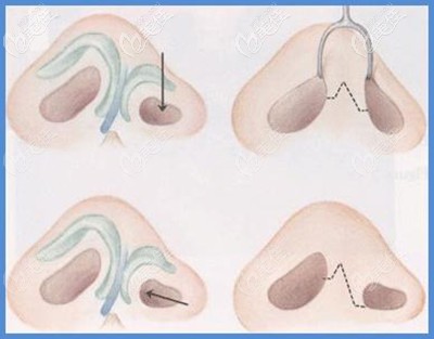 鼻翼軟骨發(fā)育不良出現(xiàn)的鼻孔不對稱修復(fù)過程 鼻翼軟骨發(fā)育不良出現(xiàn)的鼻孔不對稱修復(fù)過程