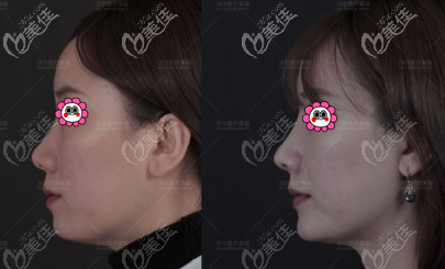 馮雁平鼻綜合案例效果參考 馮雁平鼻綜合案例效果參考