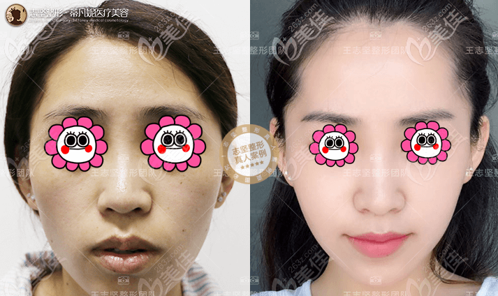 <!--<i data=20240703-sp></i>-->做面部提升怎么樣？4STCM面部提升案例效果參考