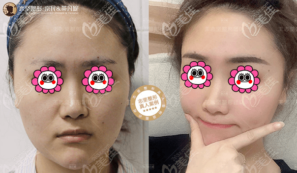 做面部提升怎么樣?三組4STCM面部年輕化手術(shù)案例一看便知