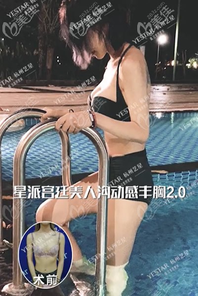 杭州藝星醫(yī)院萬連壯假體隆胸案例