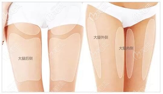 大腿抽脂的部位圖解 大腿抽脂的部位圖解