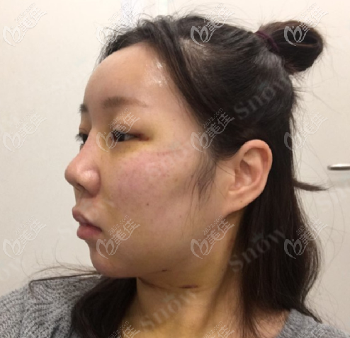 韓國snow面部吸脂+填充案例術后第六天 韓國snow面部吸脂+填充案例術后第六天