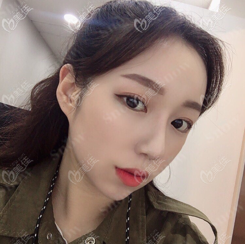 韓國snow面部吸脂+填充案例術后一個月 韓國snow面部吸脂+填充案例術后一個月