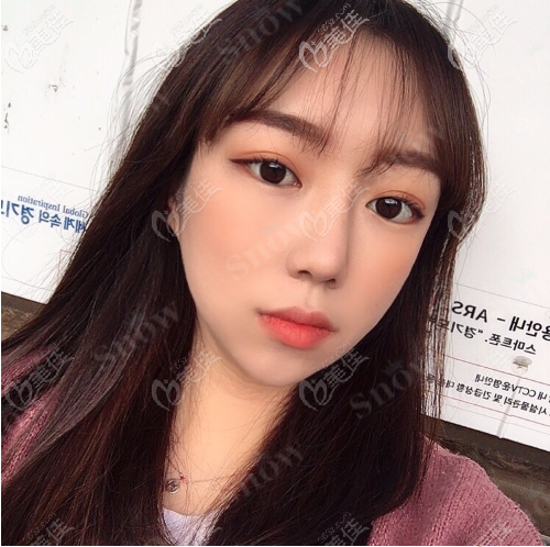 韓國snow面部吸脂+填充案例術后兩個月 韓國snow面部吸脂+填充案例術后兩個月