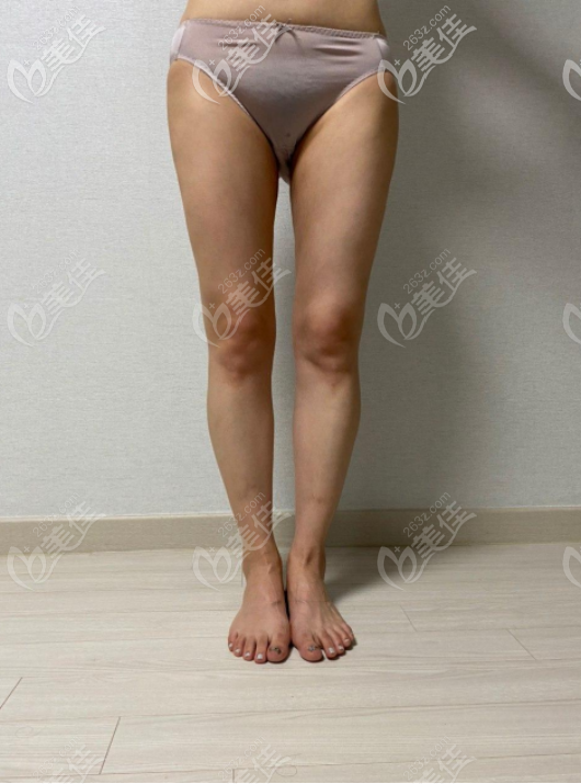 術后三個月的腿圍是47CM