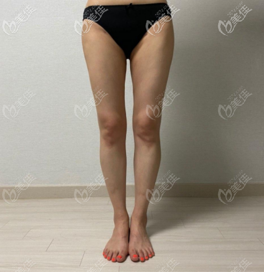 好奇大腿環(huán)吸多久可以看到效果嗎？聽(tīng)我用大腿吸脂后腿圍的變化來(lái)回答