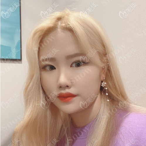 韓國snow面部吸脂真人案例術(shù)前照 韓國snow面部吸脂真人案例術(shù)前照