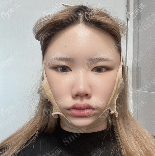 韓國snow面部吸脂真人案例術(shù)后第七天 韓國snow面部吸脂真人案例術(shù)后第七天