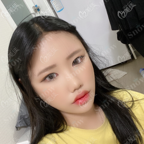 韓國snow面部吸脂真人案例術(shù)后兩個月 韓國snow面部吸脂真人案例術(shù)后兩個月